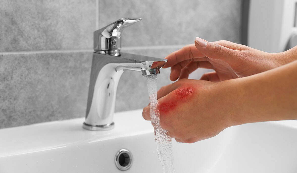 An image of someone running a burn under the tap