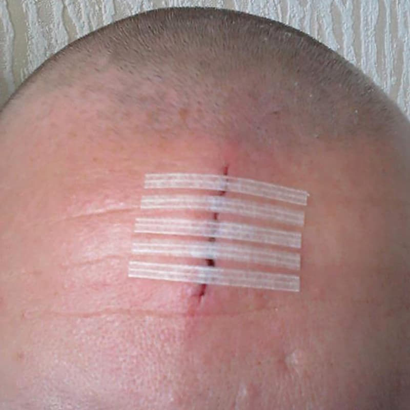 Closing a straight wound using wound closure strips