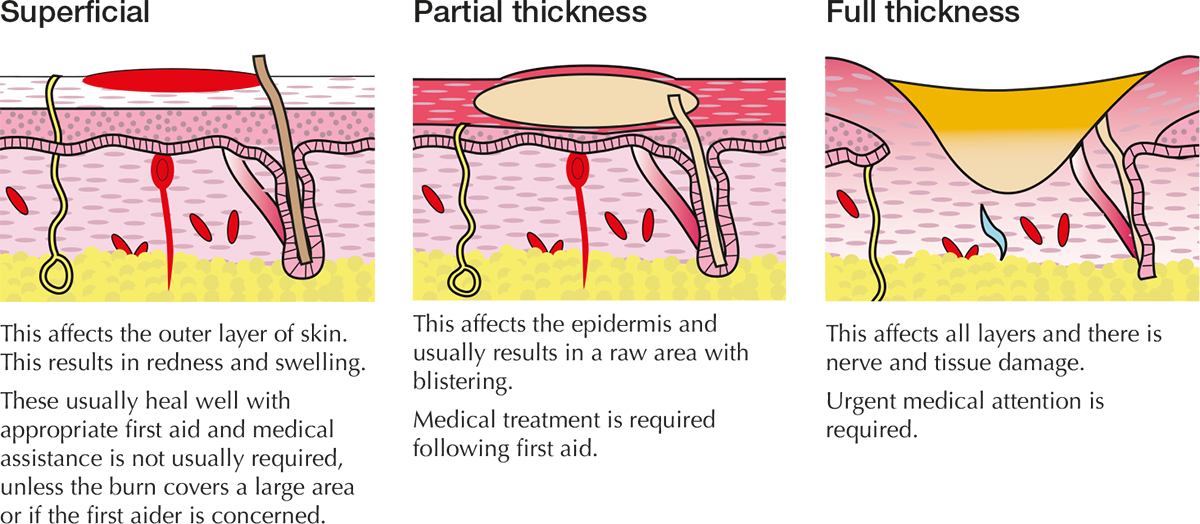 A diagram displaying the differences between superficial, partial thickness and full thickness burns. It talks about how superficial burns result in redness and swelling not usually requiring medical assistance unless they cover a large area of the body; partial thickness burns that result in a raw area with blistering and require medical treatment after first aid and full thickness burns that can cause nerve and tissue damage, requiring urgent medical attention