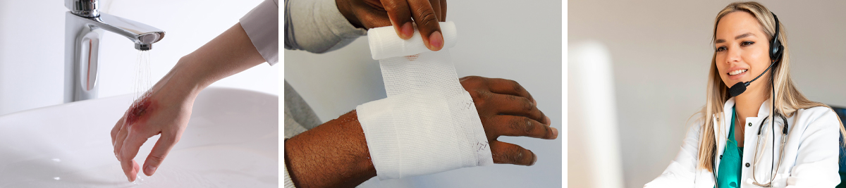 Treating a burn on hand with cool water; dressing a minor burn injury; professional advises victim of a minor burn 
