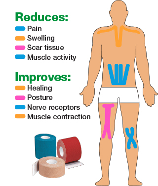 Leukotape K can reduce pain, swelling, scar tissue and muscle activity and improve healing, posture, nerve receptors and muscle contraction